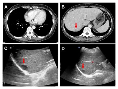 Contrast-enhanced ultrasound findings of primary hepatic non-Hodgkin’s lymphoma: a case report